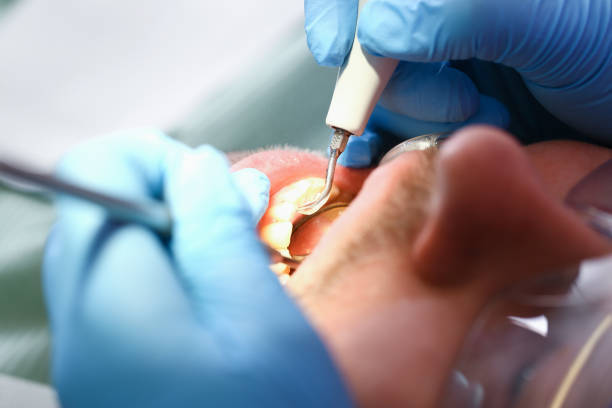 Best Emergency Dentist for Lost Fillings or Crowns in Trussville, AL